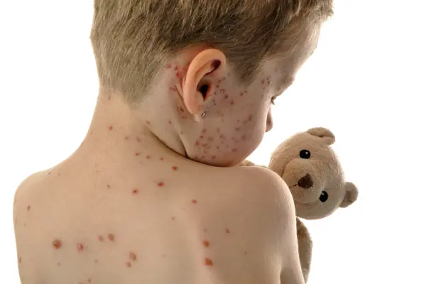 Image for article titled If you suspect your child has Measles